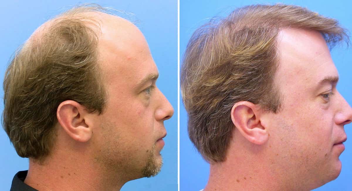 hair-transplant-before-after-pics-best-hairstyles-ideas-for-women-and