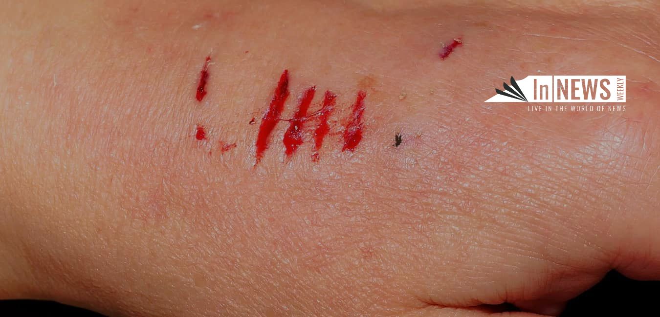 dog bite injury lawyer