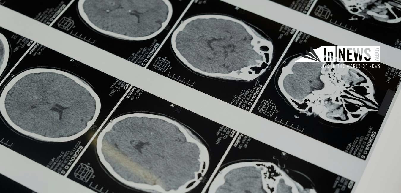 What To Do If You Have A Concussion